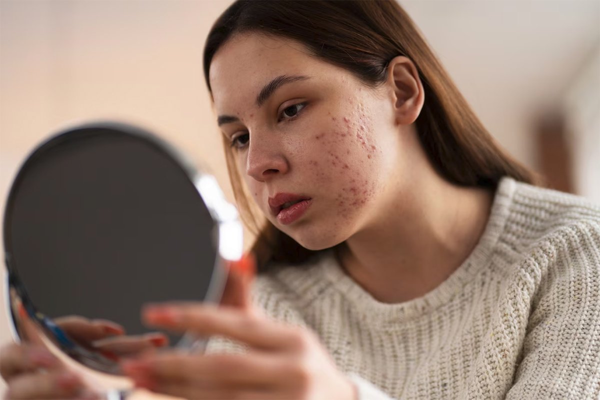 Acne Scaring Dr Rozina Asif Skin & Laser Cosmetics Clinic Mardan