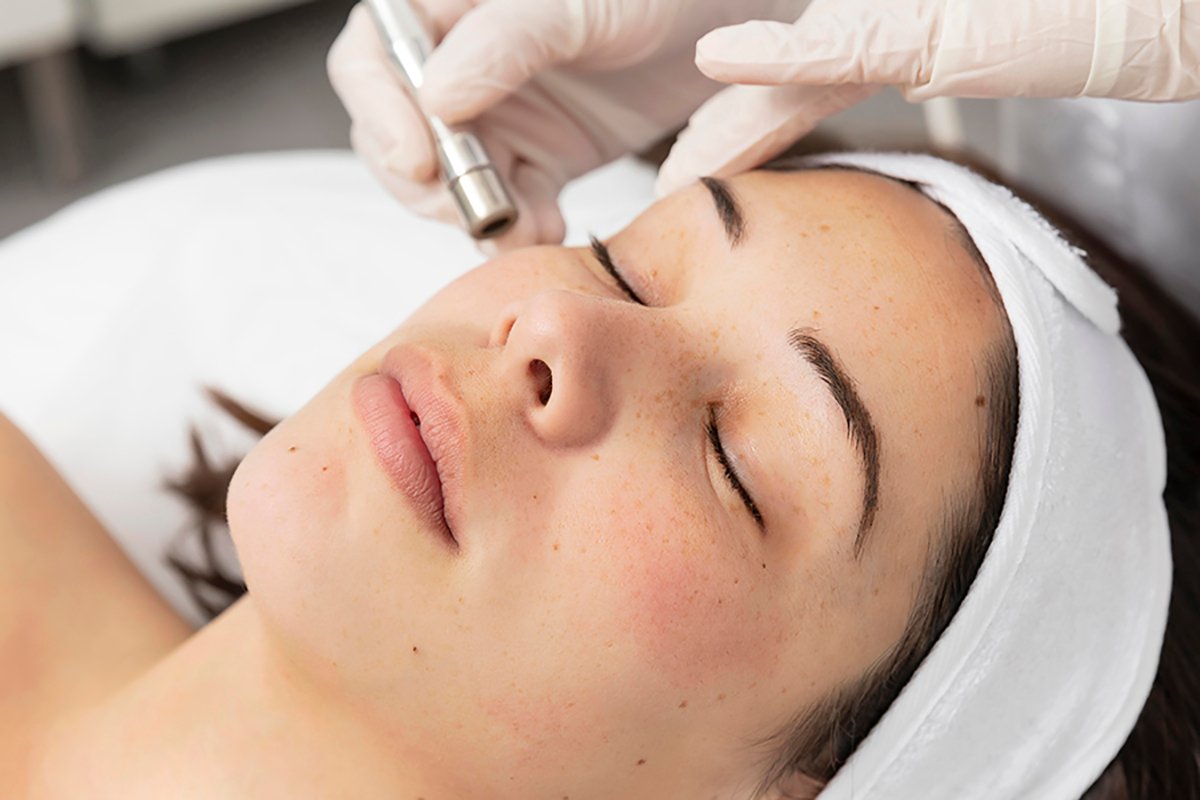 Melasma Treatment Dr Rozina Asif Skin & Laser Cosmetics Clinic Mardan